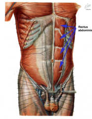 extends from inferior edge of pectoralis major down to pubic crest
tendinous intersections through muscle (make 6 pack)
semilunar line


external oblique aponeurosis-- always in front
at ribs: deep is transversus and apon.
below ribs: ex front, tr...