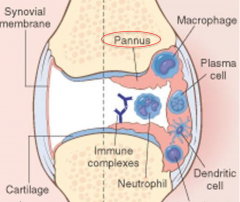 Pannus: tumor-like mass of granulation tissue that destroys articular cartilage and bone. Can lead to ankylosis