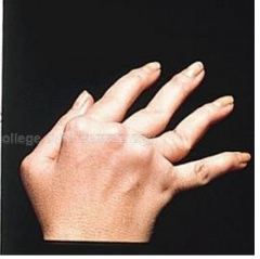 Radial deviation of the wrist, ulnar deviation of the phalangeal joints