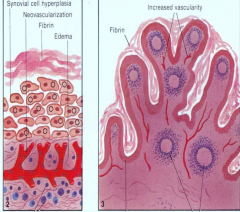 - synovial hyperplasia
- edema
- synovial membrane thickening
- increase vascularity
- fibrin deposition