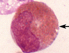 Indented Nucleus= Metamyelocyte Stage, and Orange Granules= Eosinophilic