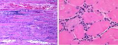 1. The cellular infiltrate is predominantly within the fascicle with inflammatory cells invading individual muscle fibers. 

2. No, this is in contrast to dermatomyositis.

3. Myofiber injury appears to be mediated directly by CD8+ cytotoxic T ly...