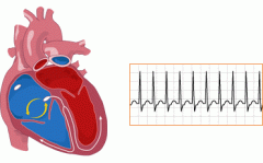 Supraventricular
 tachycardia (SVT)