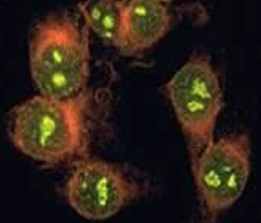 - anti-DNA topoisomerase 1 (Scl-70)


- Nucleolar ANA pattern (most sensitive of the ANA patterns) 