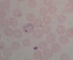 Phylum Apicomplexa, Class Coccidea, Order Haemosporida

43% of cases
Mostly in Asia
Large ring trophs
Shuffner's dots
48 hour schizogony cycles