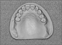 Class I : Bilateral edentulous areas located posterior to the remaining natural teeth.