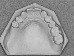 Class II: A unilateral edentulous area located posterior to the remaining natural teeth

**can cross the midline