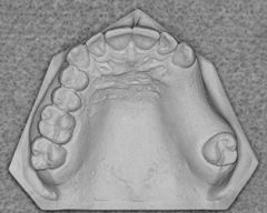 Class III : A unilateral edentulous area with natural teeth remaining both anterior and posterior to it

**does NOT cross the midline