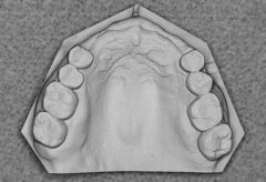 Class IV: A single but bilateral (crossing the midline) edentulous area located anterior to the remaining natural teeth