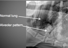 Can not see lung vessels at area of pattern
+/- air bronchograms present
+/- lobar sign present
increased lung opacity

caused by completely non-aerated portion of lung
if no air in lung, the pulmonary vessels will silhouete with lungs and b...