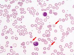 RBCs are smaller than the nucleus of the small lymphocyte.
Have markedly increased pallor, more than 1/3rd of diameter of RBC.

Causes:
IDA
Thalassemia Minor
Sideroblastic Anemia
Lead Poisoning
Pyridoxine defiency