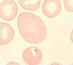 Causes:
Folate deficiency
Vit B12 deficiency
Pernicious anemia
MDS
Post Chemotherapy