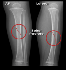 toddlers fracture