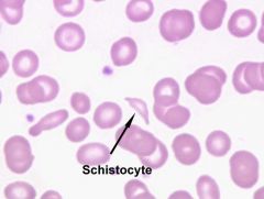 Physical damage to RBCs within bloodstream create these cells - include helmet cells, triangles, crescents and microspherocytes.
