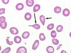 Pear shaped cells usually microcytic, hypochromic.

Causes:
Newborn
Thalassemia major
Leukoerythroblastic reaction
Myeloproliferative syndrome
