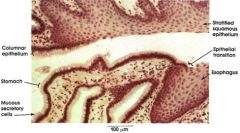 Abrupt change in epithelium. Stomach has simple columnar ep., mucous cells, and gastric pits