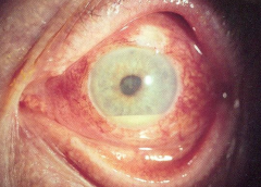 Dilated ciliary vessels
Posterior synechiae: (hence irregular pupil)
Keratic precipitate (deposition of inflammatory cells on cornea)
Hypopyon (inflammatory cells in the anterior chamber of the eye)