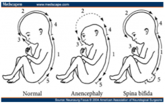 Spina bifida and Anencephaly