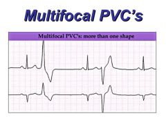 -more worrisome PVC
-2 areas of heart with irritability