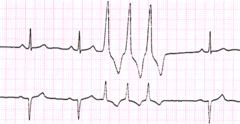 3 or more PVC's = VT
-Runs of VT are more worrisome
