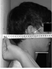 BASMI
1) Lateral lumbar flexion
2) Tragus-to-wall distance (displayed)
3) Modified Schöber's test4) Maximal intermalleolar distance (separate your legs as much as you can)
5) Cervical rotation