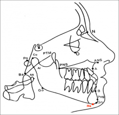 Most inferior point on the mandibular symphysis