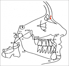 The anterior point 
of intersection of 
the frontal bone 
and nasal bone