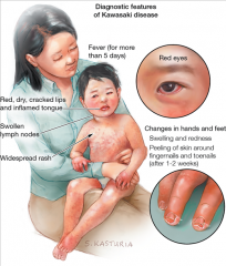 Setting: Child <5 yo

Presentation:
 - Fever for >=5 days AND (4 of the 5):

 - Bilateral conjunctivitis without exudate
 - Intraoral erythema, strawberry tongue, cracked lips
 - Nonvesicular rash
 - Erythema/swelling of hands and feet wit...