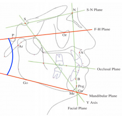 Angle between 
FH plane and 
mandibular plane.


Mean Angle 
21.9 degrees