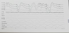 What artifact is seen in the EEG channels?