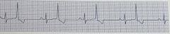 Identify the ECG rhythmRate: Depends on underlying rhythmRhythm: IrregularQRS:  >0.12 sec. Wide and bizarre.P Waves: Usually absentPR Int: NoneDescription: QRS complexes are wide and begin early.