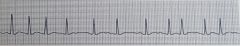 Identify the ECG rhythmRate: Atrial rate>400Rhythm: Atrial and ventricular rates are irregularQRS: Usually <0.10 secP Waves: No identifiable P wavesPR Int: NoneDescription: Unorganized atrial activity 