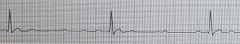Identify the ECG rhythmRate: Atrial rate> vent rate, both in normal rangesRhythm: Atrial regular, ventricular irregular QRS: >0.10sec, but is dropped periodicallyP Waves: Normal in size and configurationPR Int: Constant for each QRSDescription:  M...