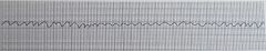 Identify the ECG rhythmRate: Cannot be determinedRhythm: Rapid and chaoticQRS: Not discernibleP Waves: Not discerniblePR Int: Not measurableDescription:   Heart is quivering rather than contracting 