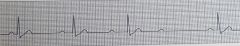 Identify the ECG rhythm Rate: Atrial rate>vent rate, both in normal rangesRhythm: Atrial regular, ventricular irregular QRS: <0.10 sec, but is dropped periodicallyP Waves: Normal in size and configurationPR Int: Lengthens w/ each cycle until QRS d...