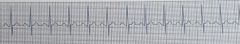 Identify the ECG rhythmRate: > 90 bpmRhythm: RegularQRS: <0.10 secP Waves: Uniform and uprightPR Int: 0.12-0.20 secDescription: Normal rhythm and intervals. Increased rate. 
