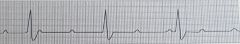 Identify the ECG rhythmRate: Atrial rate> vent rate, both in normal rangesRhythm: Atrial regular, ventricular regular QRS: May be narrow or wideP Waves: Normal in size and configurationPR Int: NoneDescription: No association between P waves and QRS 