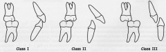 Classification system
 of occlusion based 
on the interdigitation 
of the 1st molars.