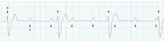 Third-Degree AV Block
complete block
tx:  pacemaker
causes:  inferior MI