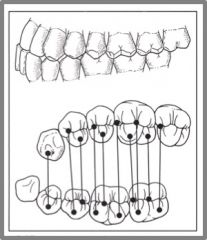 POSTERIOR DISPLACEMENT


The maxillary mesiobuccal cusp lies posteriorly to the mandibular mesiobuccal groove.
