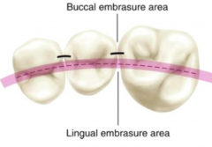 Anterior Teeth: contact divides the tooth equally (B & L embrasures are equal)


Posterior Teeth: contact occurs more buccally (lingual embrasure larger than buccal embrasure)