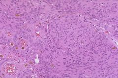 This is a microscopic slide of a meningioma. Identify the characteristic histological features present.
