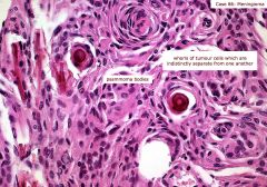Whorls of meningothelial cells - when calcified, these become known as 'psamomma bodies'

