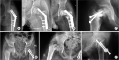 pediatric basicervical fem neck fx. Femoral neck fx in the ped pop have high rate of osteonecrosis. They are divided: epiphyseal, transcervical, basicervical and intertrochanteric. Fracture displacement, age over ten years and an epiphyseal or tra...