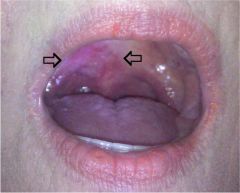 on the oral surface of the soft palate
