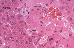 What pathology is seen on the right side of the image?


Is this process still reversible in the cells with the arrows?