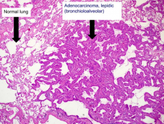 What kind of lung cancer is associated with this image?