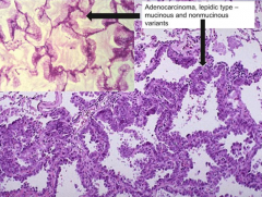 - Nonmucinous (Clara cells, type 2 pneumocytes) - 2/3 of cases
- Mucinous (tall columnar mucinous cells) - worse prognosis