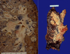 - Submucosal / circumferential infiltration
- Rare endobronchial polypoid growth
- Extensive necrosis, crush artifact
- Secretory granules of neuroendocrine type