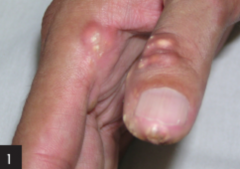 CREST (v/undertypen begrenset sklerodermi)

C - calcinose (ytterst på fingre, eller over sener, se bildet, smertefullt)
R - raynaud
E - eosophagal dysmotilitet (LES-skade, PPI-beh)
S - sklerodaktyli
T - teleangiektasier
